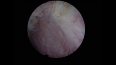 Лазерная тулиевая en-bloc резекция стенки мочевого пузыря с опухолью